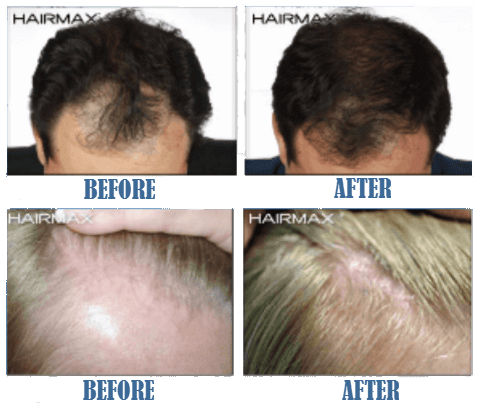 hairmax lasercomb before and after result